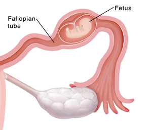 Fetus in fallopian tube.