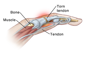 Internal view of finger showing bone, muscle, tendon, and a torn tendon.