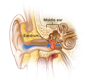 Arrow showing high pressure pushing against eardrum on external ear side and arrow showing low pressure pushing against eardrum on middle ear side.