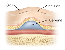 Seroma showing surgical incision at surface of skin.