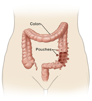 Outline of the lower body showing the colon and diverticulosis pouches.