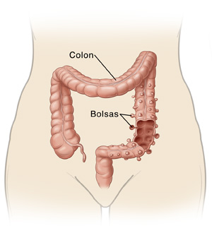 Bosquejo de la parte inferior del cuerpo donde se observan el colon y bolsas de divertículos.