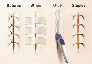 Closeup of incisions showing stitches, steri-strips, glue, and staples closing wound.