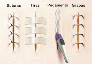 Primer plano de incisiones donde se observan cierres con suturas, tiras para cierres de heridas, pegamento y grapas.