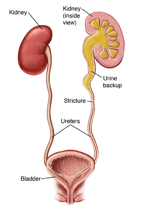 Inside view of kidneys, ureters, and bladder. Left ureter is closed off with urine backing up into kidney.