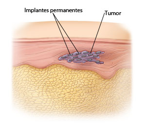Corte transversal de la piel donde se ve un tumor con 13&nbsp;pequeños gránulos en su interior.