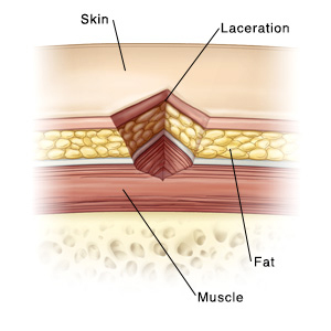 Cross-section of skin showing layers of muscle, fat, and a laceration.