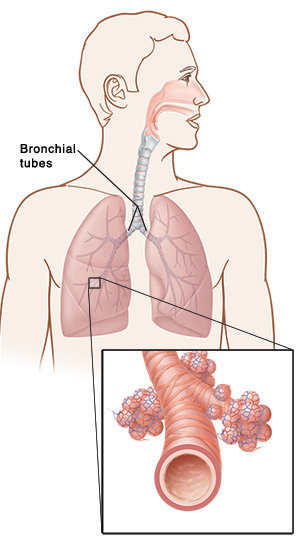 Outline of man's upper body showing bronchial tubes, lungs, and close-up inset of bronchial tubes and alveoli.