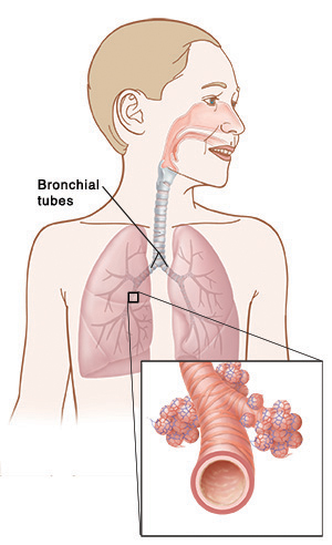 Front view of child's chest, showing the position of the lungs and bronchial tubes, with a close-up view of a bronchial tube and air sac.