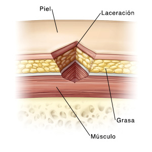 Piel, laceración, músculo, grasa