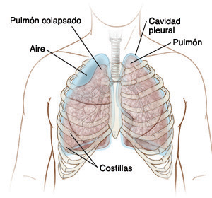 Pulmón colapsado, aire, costillas, cavidad pleural, pulmón
