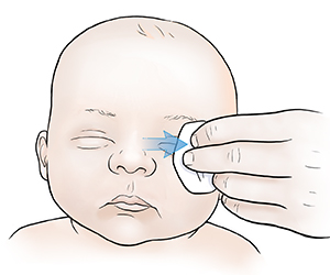 Adult hand wiping infant's eyelid with cloth, wiping from the nose to the outer eye.