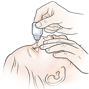 Adult hands putting eyedrops in child's eye.