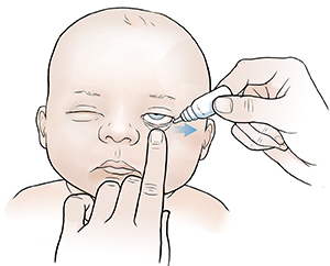 Ointment being put into lower lid of infant's eye.