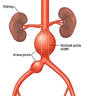 Vista frontal de la aorta abdominal con aneurismas. La línea de puntos muestra el ancho normal de la aorta.