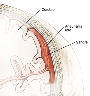 Corte transversal de un cerebro dentro de un cráneo en donde se muestra la rotura de un aneurisma en un vaso sanguíneo en la superficie del cerebro. La sangre de la hemorragia está entrando en el espacio que existe entre el cerebro y el cráneo.
