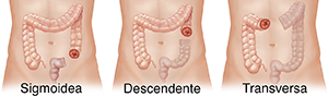 Vista frontal de tres abdómenes masculinos. Puede verse el colon en imagen fantasma, con una colostomía sigmoidea, descendente y transversa.