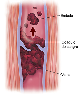 Corte transversal de vena varicosa con trombo y émbolo.