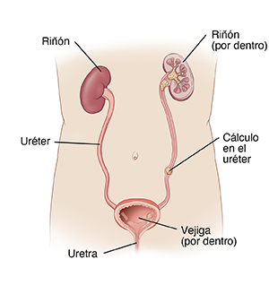 Ilustración en la que se ve la anatomía del aparato urinario, que incluye los riñones, la vejiga, la uretra y un cálculo en el uréter.