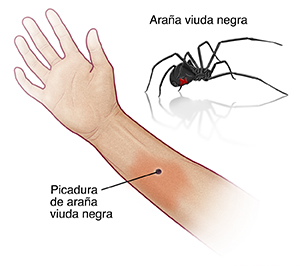 Vista de mano y antebrazo con la palma hacia arriba donde se observa una picadura de araña viuda negra. Imagen de una araña viuda negra.