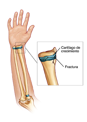 Vista de la cara interna del antebrazo donde se observan los huesos del brazo y una fractura de cartílago de crecimiento.