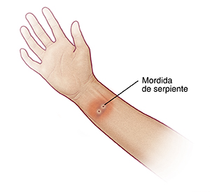 Imagen de una mordida de serpiente en la parte interior de la muñeca.