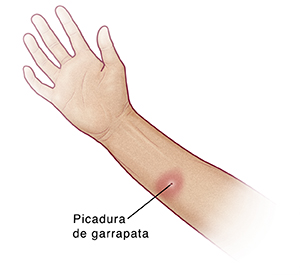 Vista de la mano y del antebrazo con la palma hacia arriba donde se observa una picadura de garrapata en el brazo.