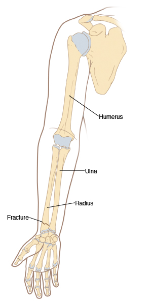 Illustration showing the outline and bones of the arm, including the humerus and ulna, and a fracture in the radius.