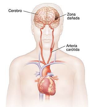 Vista frontal de la cabeza y parte superior del cuerpo en donde se observan el corazón, las arterias carótidas y el daño en el cerebro.