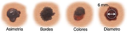 Lunar con forma asimétrica. Lunar con bordes desiguales e indefinidos. Lunar con manchas claras y oscuras. Lunar con un diámetro transversal de 6&nbsp;mm.