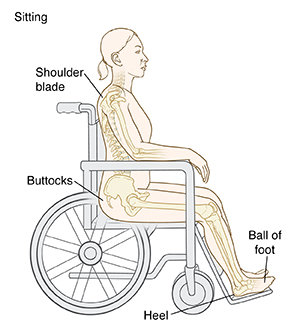 Person sitting in wheelchair, showing areas where pressure injuries happen, at the shoulder blade, buttocks, ball of foot, and heel.