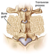 Back view of lumbar vertebrae showing bone graft between transverse processes.