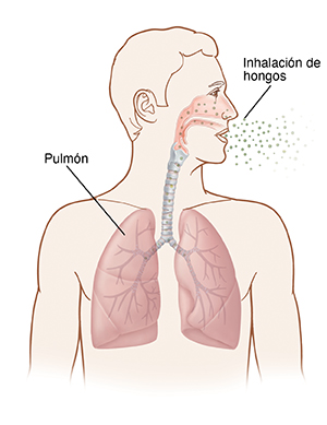 Contorno de la cabeza y el pecho humanos con la cabeza girada hacia un lado. Dentro de la nariz, la tráquea y los pulmones son visibles. El hongo está siendo inhalado por la nariz y los pulmones.