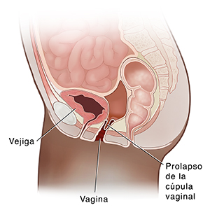 La sección transversal lateral de la pelvis femenina muestra prolapso de la bóveda vaginal.