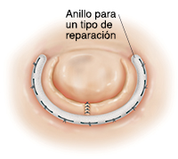 Vista superior de válvula del corazón reparada con un anillo en forma de C cosido alrededor de la válvula.