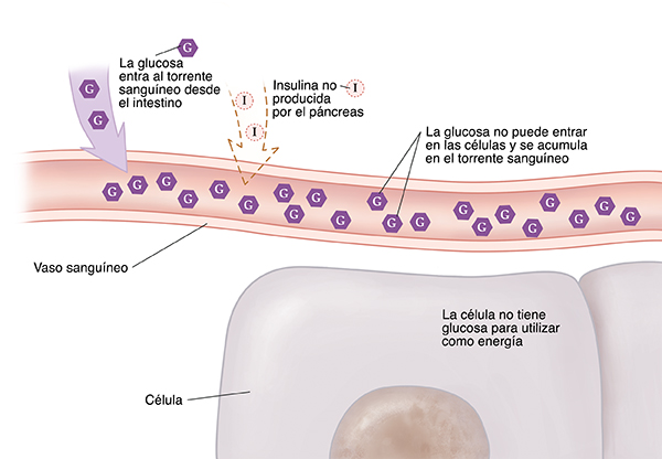 Primer plano de un corte transversal de un vaso sanguíneo cerca de células donde se muestra la diabetes tipo&nbsp;1. No se produce insulina. La glucosa no puede entrar en las células y se acumula en el torrente sanguíneo. La célula no tiene glucosa para utilizar como energía.
