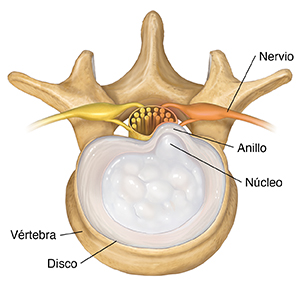 Vista superior de una vértebra lumbar que muestra un disco herniado contenido.