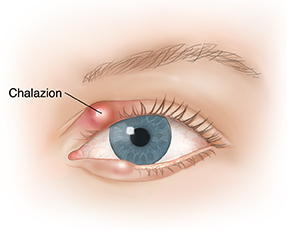 Front view of eye showing chalazion.