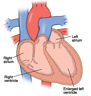 View of heart showing right and left atrium and right and left ventricle. The left ventricle is enlarged.