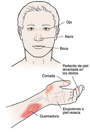 La cabeza y el brazo de un hombre con lesiones por quemadura, sarpullido y corte en la piel.