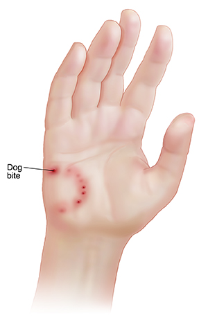 Palm of hand with dog bite marks.