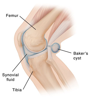 Side view of bent knee showing Baker's cyst behind the knee.