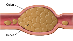 Corte transversal del colon con heces duras en el interior.