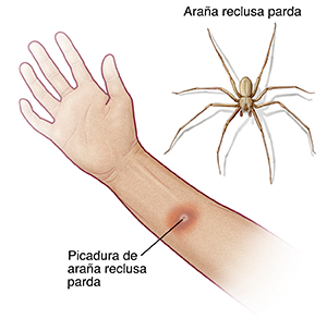 Vista de mano y antebrazo con la palma hacia arriba donde se observa picadura de araña reclusa parda. Imagen de araña reclusa parda.