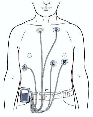 Man's torso showing five ECG leads attached to chest and connected to Holter monitor clipped to belt.