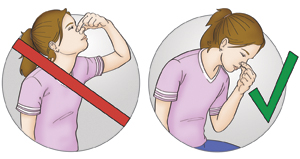 Person with nosebleed, incorrectly pinching nose and holding head back, and correctly pinching nose while bending head forward.