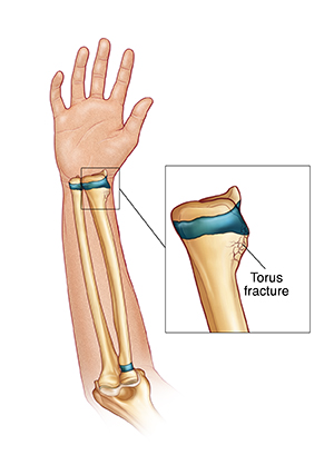 Hand and arm with palm up showing bones and torus fracture of radius.