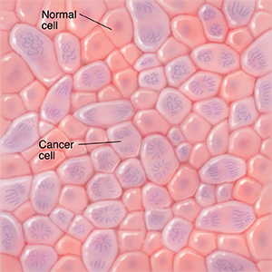 Microscopic view of normal cells and cancer cells.