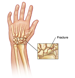 Bones of hand and wrist, with closeup of fracture of wrist bone.