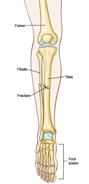 Outline of lower leg and foot showing femur, foot bones, and fractures in fibula and tibia.